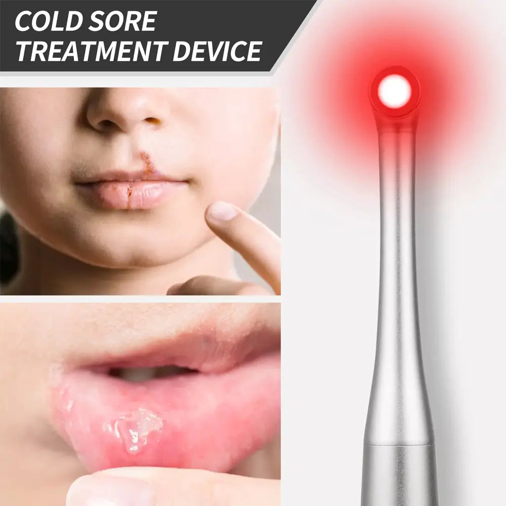 Red Light Therapy Wand Device •Treatment for Fever Blister, Canker Sore Mouth Sore Relief